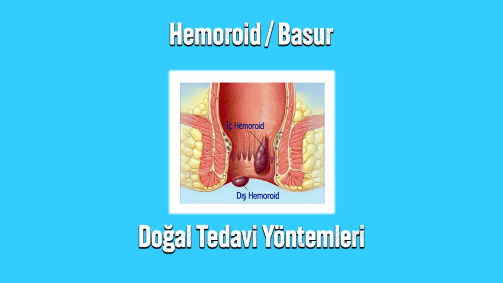 Hemoroid Basur Doğal Tedavi Yöntemleri